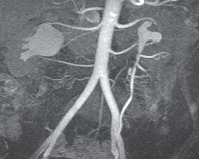 Уретеро-вазальный конфликт вследствие раннего деления основного ствола почечной артерии правой почки - магнитно-резонансная ангиография