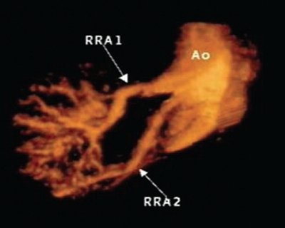 Уретеро-вазальный конфликт вследствие раннего деления основного ствола почечной артерии правой почки - трехмерная ультразвуковая ангиография с диуретической нагрузкой (режим MIP)