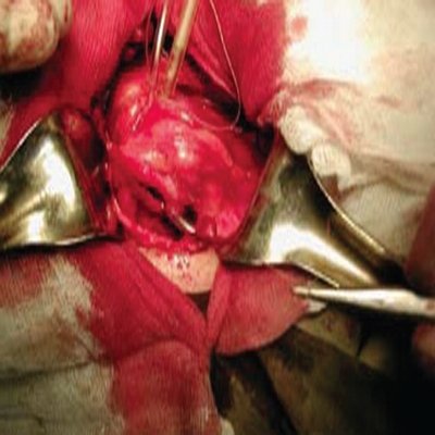 Уретеро-вазальный конфликт, вызванный добавочной почечной артерией, отходившей от общей подвздошной артерии - пластика лоханочно-мочеточникового сегмента с наложением антевазального анастомоза (д)