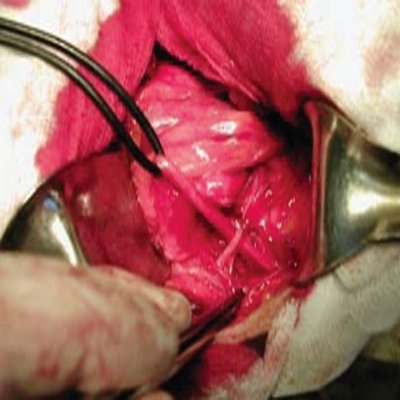 Уретеро-вазальный конфликт, вызванный добавочной почечной артерией, отходившей от общей подвздошной артерии - пластика лоханочно-мочеточникового сегмента с наложением антевазального анастомоза (г)