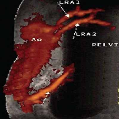 Уретеро-вазальный конфликт, вызванный добавочной почечной артерией, отходившей от общей подвздошной артерии - трехмерная ультразвуковая ангиография с диуретической нагрузкой