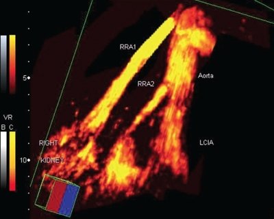 Добавочная почечная артерия справа - трехмерная ультразвуковая ангиография с диуретической нагрузкой в режиме MIP