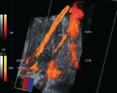 Добавочная почечная артерия справа - трехмерная ультразвуковая ангиография с диуретической нагрузкой (комбинация режимов MIP и MIN)