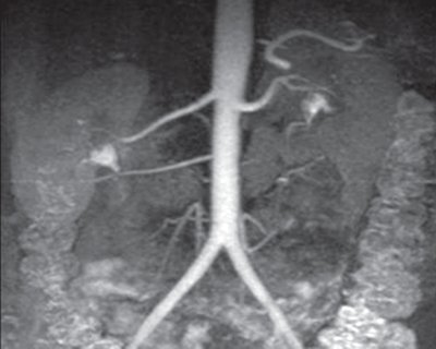 Добавочная почечная артерия справа - магнитно-резонансная ангиография