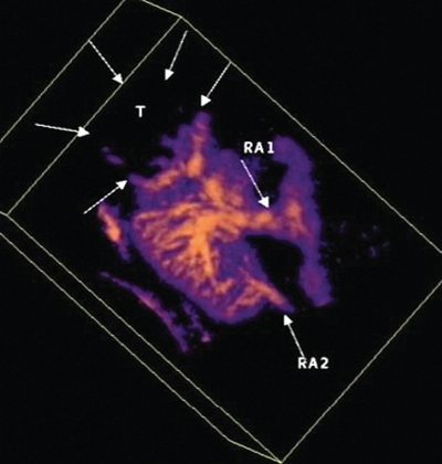 Добавочная нижнеполярная почечная артерия у пациента с опухолью правой почки - трехмерная ультразвуковая ангиография с диуретической нагрузкой