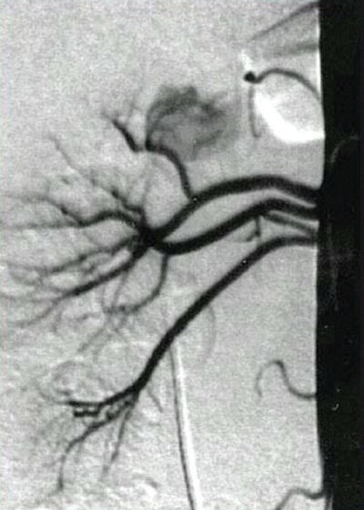 Две добавочные почечные артерии правой почки - рентгеновская ангиография