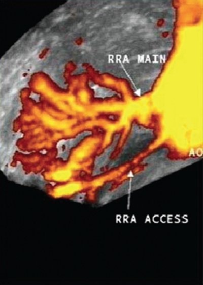Две добавочные почечные артерии правой почки - трехмерная ультразвуковая ангиография с диуретической нагрузкой (б)