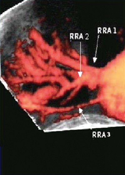 Две добавочные почечные артерии правой почки - трехмерная ультразвуковая ангиография с диуретической нагрузкой (в)
