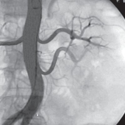 Левосторонняя двойная почечная артерия - рентгеновская ангиография