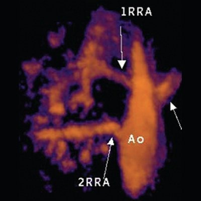 Уретеро-вазальный конфликт, обусловленный наличием нижнеполярной добавочной почечной артерии - трехмерная ультразвуковая ангиография с диуретической нагрузкой в режиме MIP