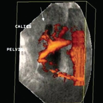 Уретеро-вазальный конфликт, обусловленный наличием нижнеполярной добавочной почечной артерии - трехмерная ультразвуковая ангиография с диуретической нагрузкой (комбинация режимов MIP и MIN)