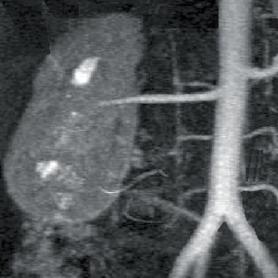 Уретеро-вазальный конфликт, обусловленный наличием нижнеполярной добавочной почечной артерии - магнитно-резонансная ангиография