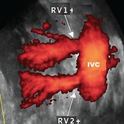 Уретеро-вазальный конфликт, обусловленный наличием двойной почечной артерии - трехмерная ультразвуковая ангиография с диуретической нагрузкой
