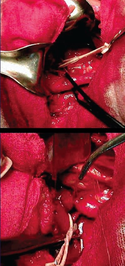 Уретеро-вазальный конфликт, обусловленный наличием двойной почечной артерии - пластика лоханочно-мочеточникового сегмента с наложением антевазального анастомоза