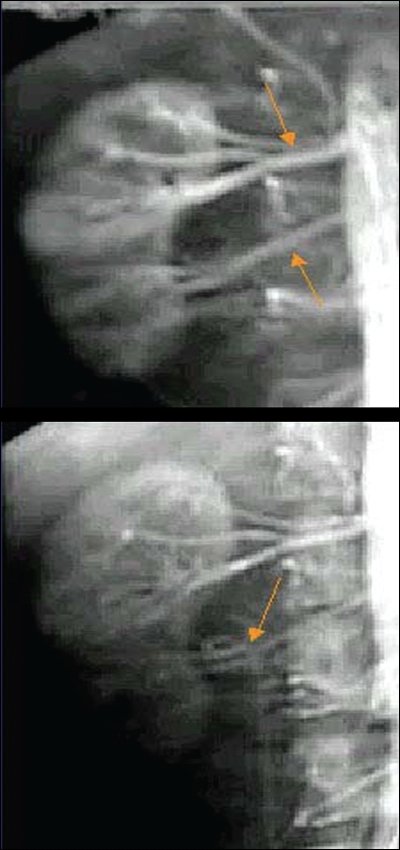 Уретеро-вазальный конфликт, обусловленный наличием двойной почечной артерии - МР-ангиография с МР-урографией
