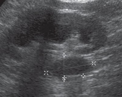 Стриктура лоханочно-мочеточникового сегмента левой почки без развития уретеро-вазального конфликта - УЗИ (В-режим)