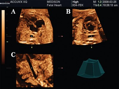 Сердце плода в мультипланарном режиме - курсор расположен на уровне грудного отдела аорты