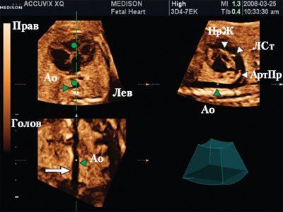 Сердце плода в мультипланарном режиме - курсор расположен на уровне нисходящей аорты