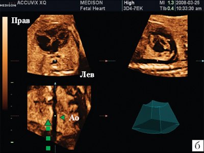 Сердце плода в мультипланарном режиме - на С-плане курсор смещен вдоль нисходящей аорты вверх по направлению к голове и шее плода
