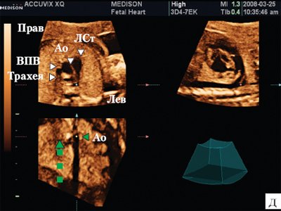 Сердце плода в мультипланарном режиме - смещение курсора на С-плане вдоль нисходящей аорты вверх по направлению к головному концу плода