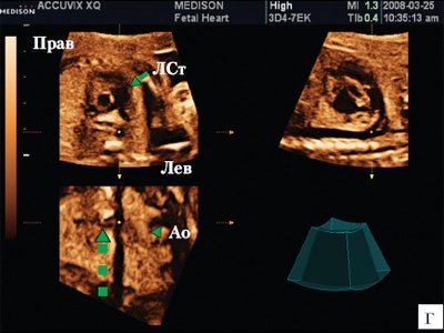 Сердце плода в мультипланарном режиме - смещение курсора на С-плане вдоль нисходящей аорты вверх по направлению к головному концу плода