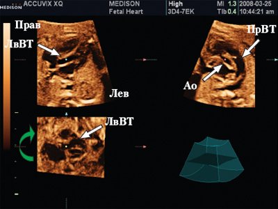 Сердце плода в мультипланарном режиме - курсор расположен на уровне аортального клапана