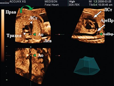 Сердце плода в мультипланарном режиме - курсор расположен на уровне нисходящей аорты