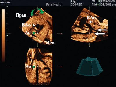 Сердце плода в режиме мультипланарной визуализации - курсор расположен на уровне нисходящей аорты на всех трех планах