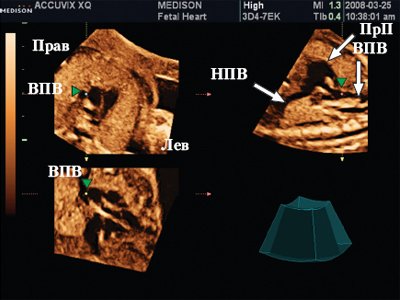 Сердце плода в режиме мультипланарной визуализации - курсор расположен на уровне ВПВ на всех трех планах