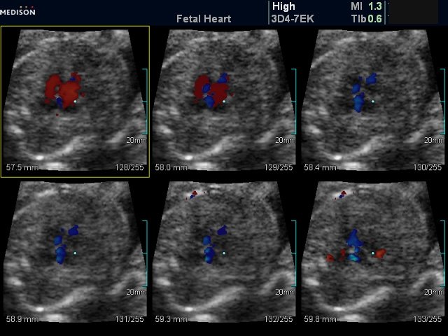 Множественные дефекты в межжелудочковой перегородке сердца плода (беременность 20 недель)