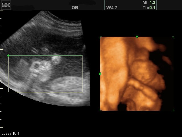 Анэнцефалия, срединная расщелина верхней губы и неба (беременность 15-16 недель)