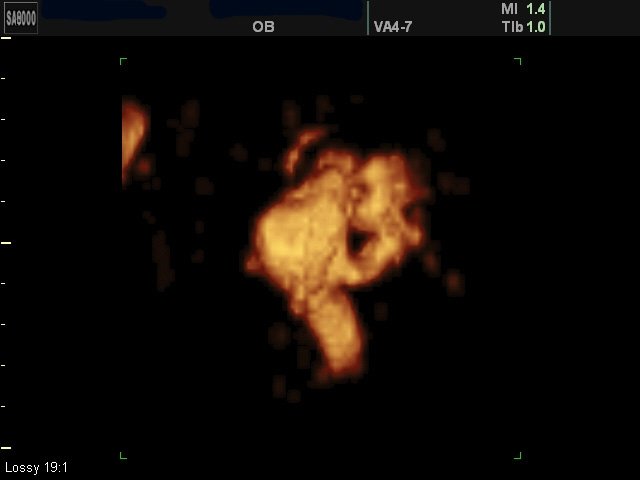 Аневризма вены Галена, визуализируются фрагменты аномальной сосудистой системы головного мозга плода (беременность 32 недели)