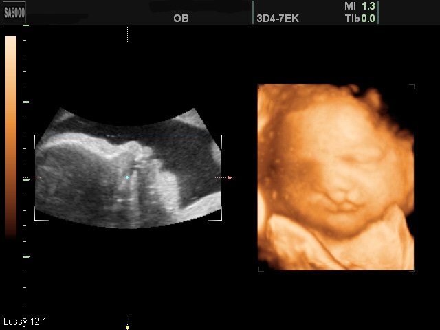Двусторонний боковой хейлогнатопалатосхизис (расщелина верхней губы и неба), беременность 30 недель