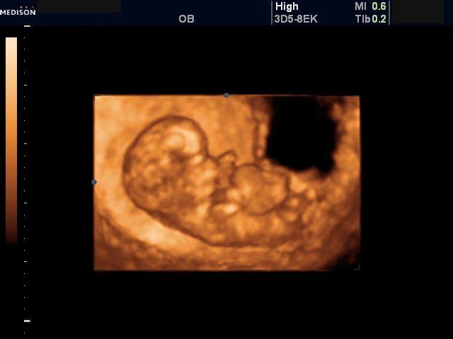 Омфалоцеле (беременность 10-11 недель)