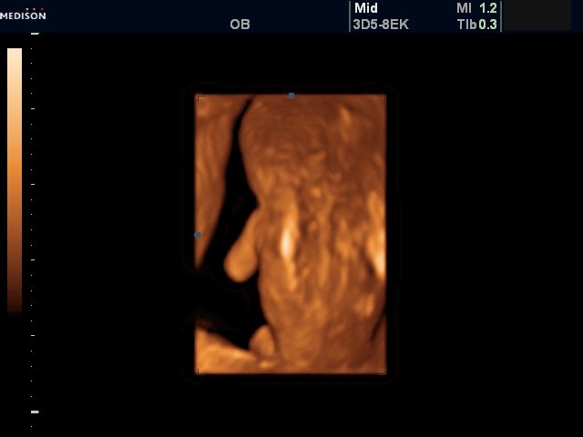 Spina bifida в шейном, грудном и поясничном отделах (беременность 11-12 недель)