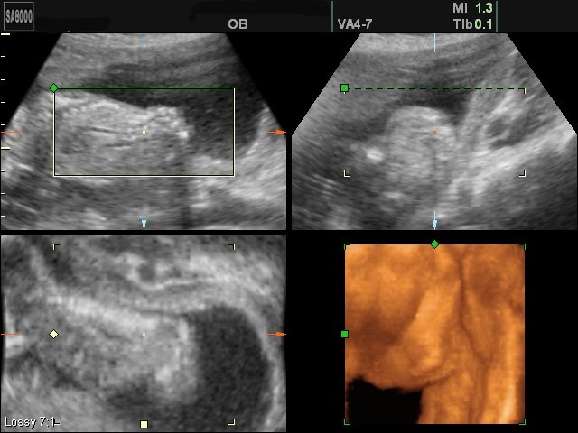 Менингомиелоцеле в пояснично-крестцовом отделе позвоночника (беременность 20 недель)