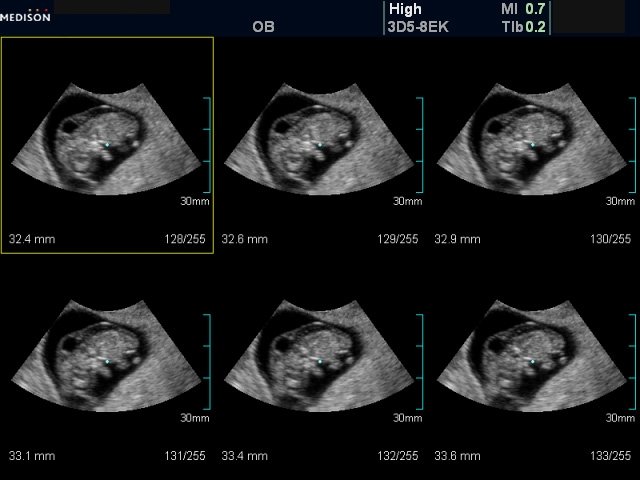 Трансвагинальное сканирование - воротниковое пространство (беременность 10-11 недель)