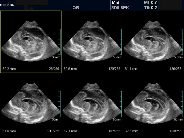 Агенезия мозолистого тела, коммуникантная наружно-внутренняя гидроцефалия, лисэнцефалия (агирия) - беременность 20-21 неделя
