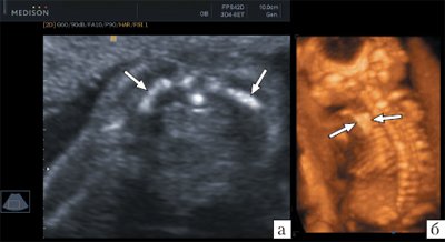 Кампомелическая дисплазия, стрелками указаны гипоплазированные лопатки плода (беременность 18 недель)