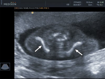 Эхограмма ключиц (стрелки) плода в 16 недель беременности
