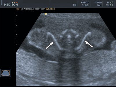 Эхограмма ключиц (стрелки) плода в 22 недели беременности