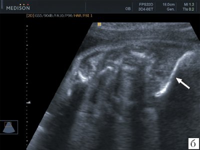 Эхограмма левой ключицы плода в 26 недели беременности
