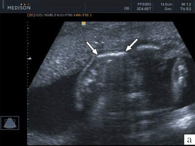 Эхограмма лопатки (стрелки) плода при поперечном сканировании