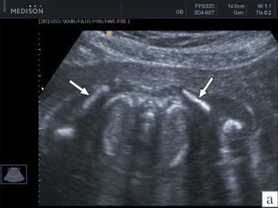 Эхограмма лопаток (стрелки) плода в 20 недель беременности