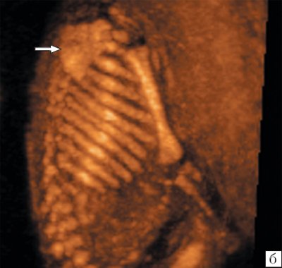 Объемная реконструкция в режиме максимальной интенсивности для исследования костей плода в разных плоскостях сканирования, стрелкой указана лопатка плода
