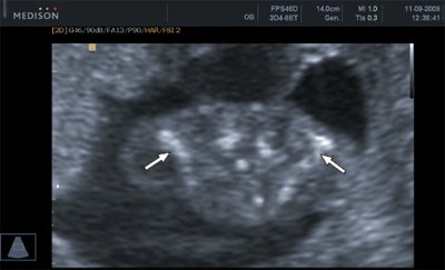 Клейдокраниальная дисплазия, стрелками указаны гипоплазированные ключицы плода (беременность 16 недель)
