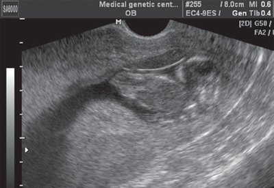 Эхограмма плода при сагиттальном трансвагинальном сканировании