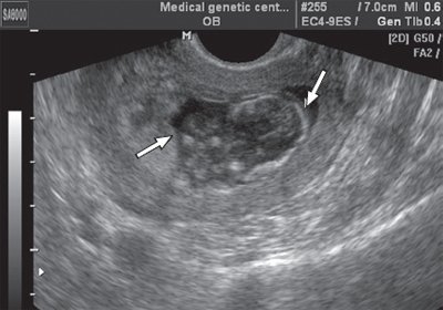 Эхограмма плода при поперечном трансвагинальном сканировании