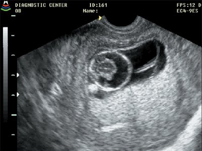 Голопрозэнцефалия, беременность 11 недель 5 дней