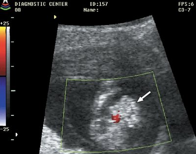 Гастрошизис (стрелка), беременность 13 недель 1 день